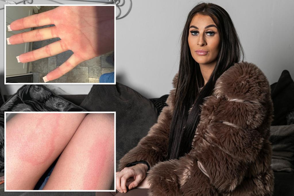 Mom with extremely rare allergies reveals how life is a 'daily war'
