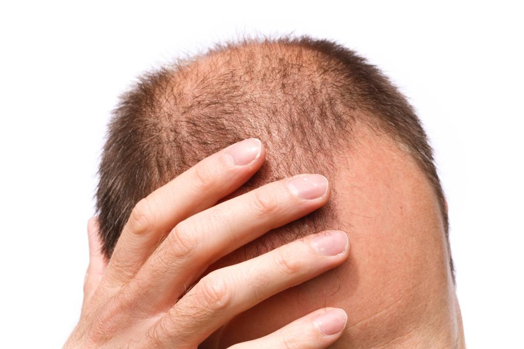 What many people don't understand about hair transplant operation